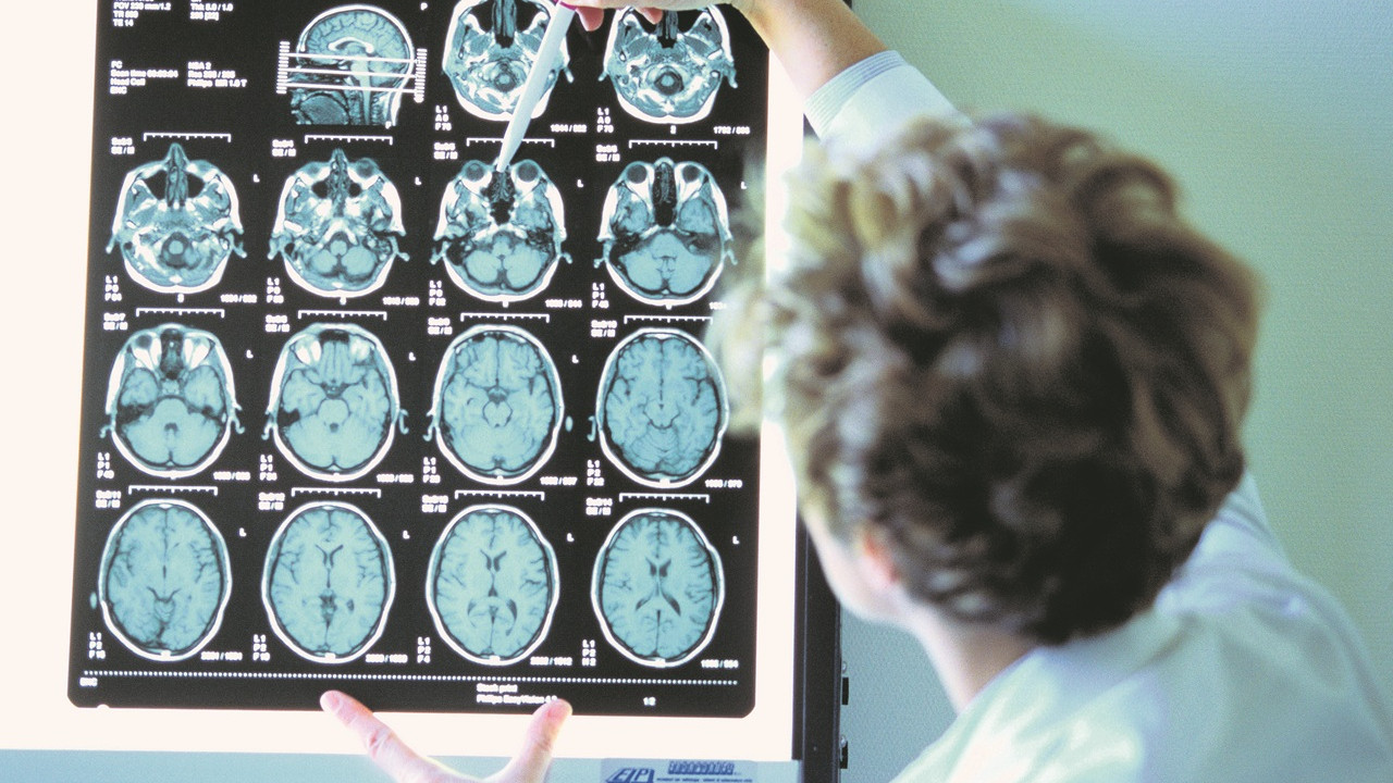 Menopoz'da Beyin Değişiklikleri: Gri Madde Kaybı ve Demans Riski