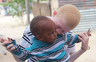 Afrika'da albino bireyler batıl inançlar nedeniyle ölüm tehdidi alıyor