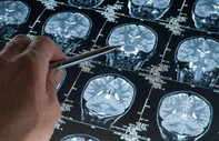 Bilim insanları geliştirdi: Yeni bir kan testi Alzheimer hastalığını erken evrede tespit edebiliyor