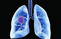 Akciğer kanserinde neredeyiz?