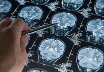 Yeni araştırma: Alzheimer düşünüldüğünden daha erken başlayabilir