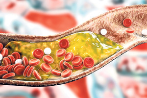 Kolesterol düşürmede yeni bir çağ başlıyor