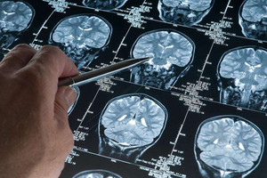Yeni araştırma: Alzheimer düşünüldüğünden daha erken başlayabilir