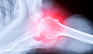 Osteoporoz: Uzayan hayatta sessizce kırılan kemikler