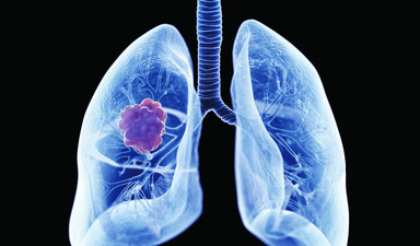 Akciğer kanserinde neredeyiz?