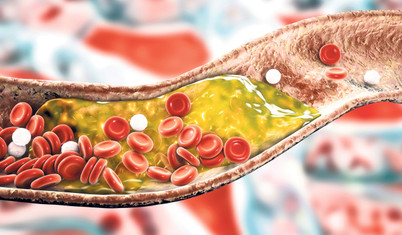 Kolesterol düşürmede yeni bir çağ başlıyor