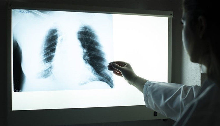 DSÖ raporu: Geçen yıl 1,2 milyonu aşkın kişi tüberkülozdan öldü