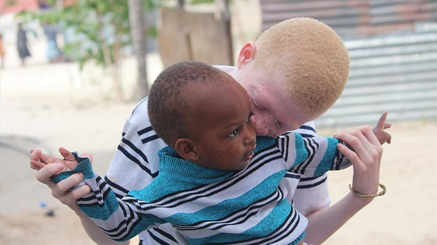 Afrika'da albino bireyler batıl inançlar nedeniyle ölüm tehdidi alıyor