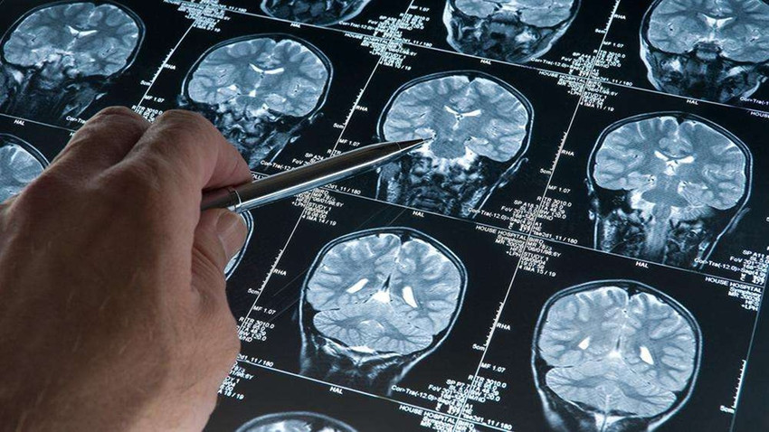 Bilim insanları geliştirdi: Yeni bir kan testi Alzheimer hastalığını erken evrede tespit edebiliyor