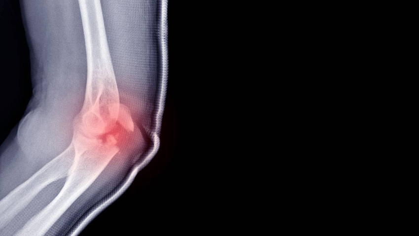 Dirseğini kıran kadına hastane 97 bin dolarlık fatura çıkardı