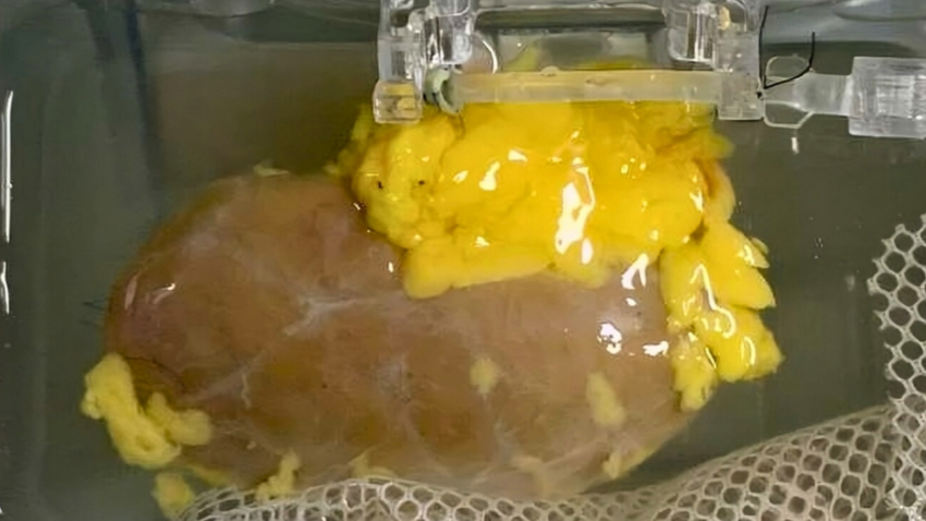 Science Alert "çığır açan buluş" diyerek duyurdu: Her kan grubuna uyacak "evrensel böbrek" üretildi