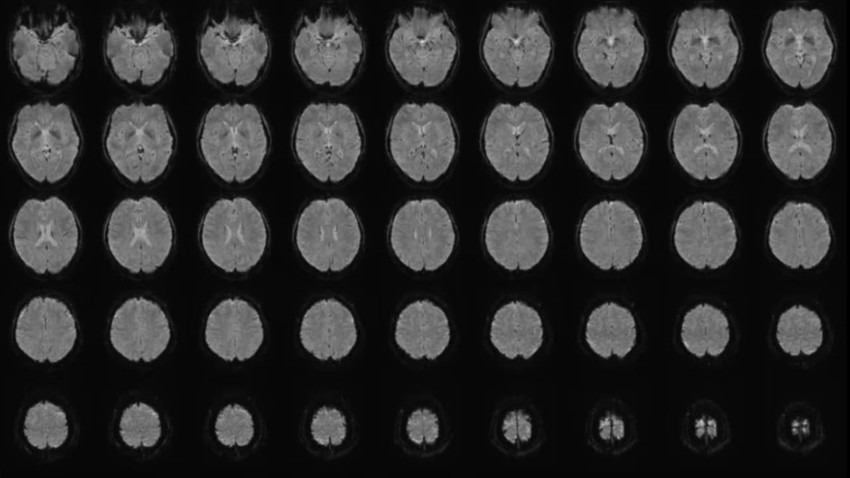 Zihin okuma gerçek oldu: Yapay zeka artık düşünceleri metne çevirebiliyor