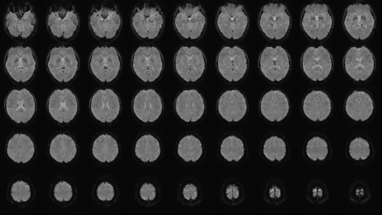 Zihin okuma gerçek oldu: Yapay zeka artık düşünceleri metne çevirebiliyor
